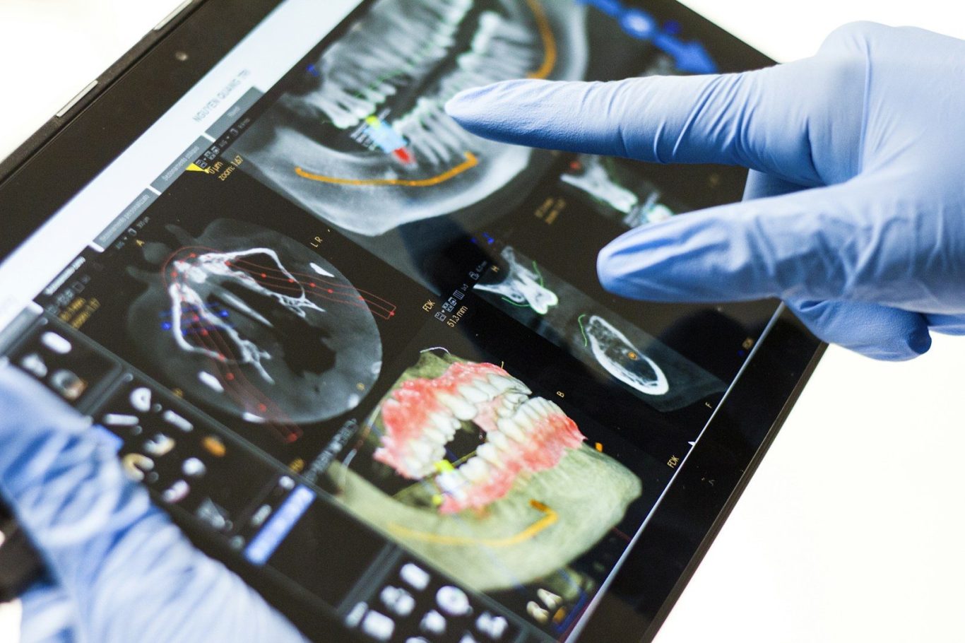 Digitale Implantatplanung
