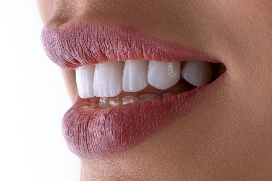 Ästhetische Zähne Veneers